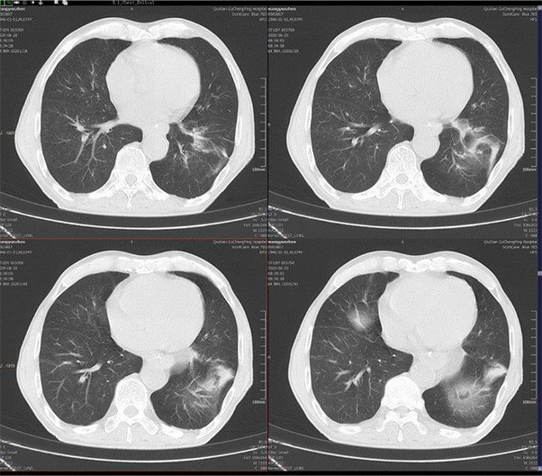 Cortes axiales de tórax obtenidos con tomógrafo Mindfound, utilizados para evaluación pulmonar detallada en estudios clínicos de alta resolución.