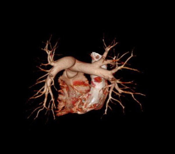 Reconstrucción 3D del corazón y vasos pulmonares obtenida con tomógrafo computarizado Mindfound, ideal para diagnóstico cardiovascular avanzado.