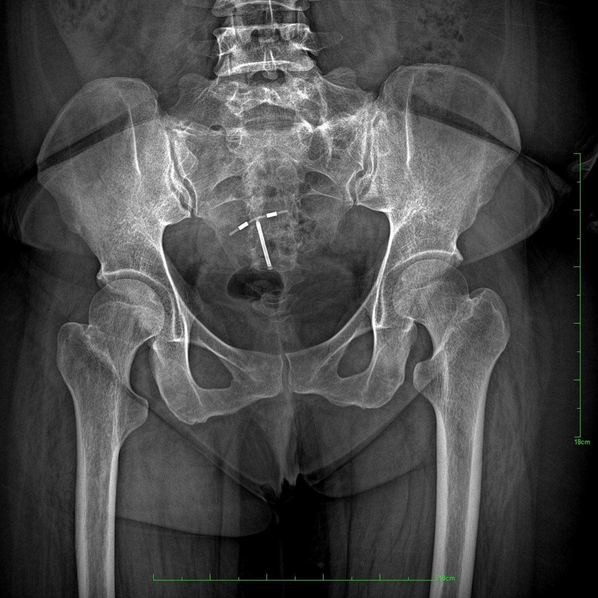 Radiografía de pelvis por serie realizada con equipo IMS Vulcan, ideal para estudios ortopédicos y evaluación clínica detallada