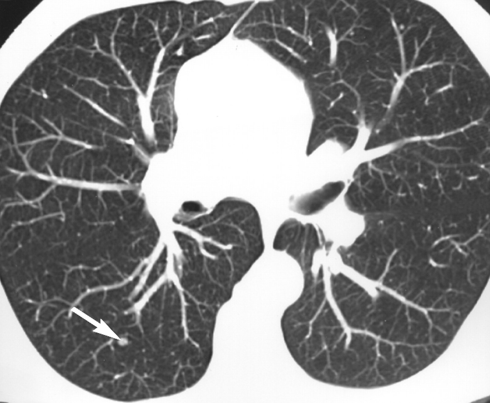 Tomografía Computarizada Pulmonar con Reconstrucción MIP | Evaluación de Nódulos