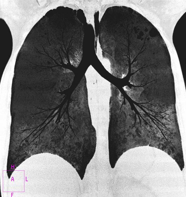 Reconstrucción MinIP Pulmonar en Tomografía Computarizada | Evaluación de la Vía Aérea