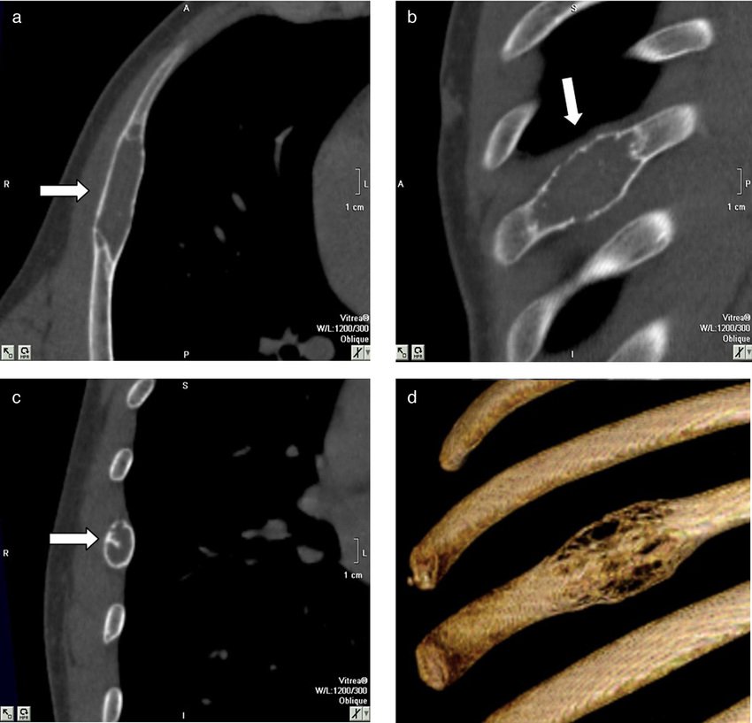 Reconstrucción Ósea y Ventana Pulmonar en Tomografía Computarizada | Evaluación de Costillas