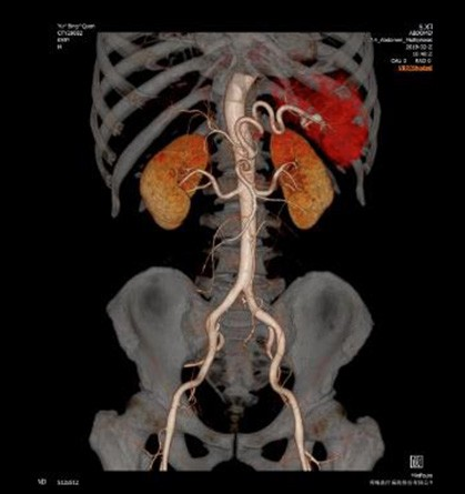 Reconstrucción 3D con Volume Rendering en Tomografía Computarizada | Anatomía Vascular