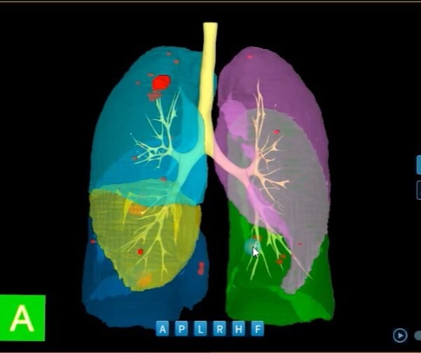 Análisis de Nódulos Pulmonares con IntelliAtlas Pro