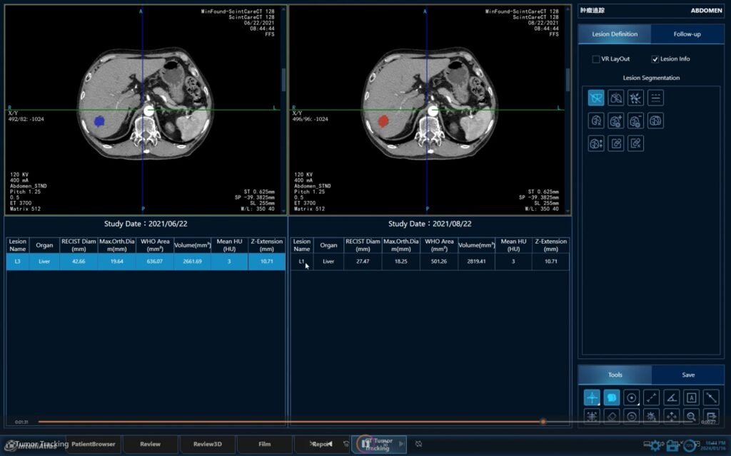 tumor traking