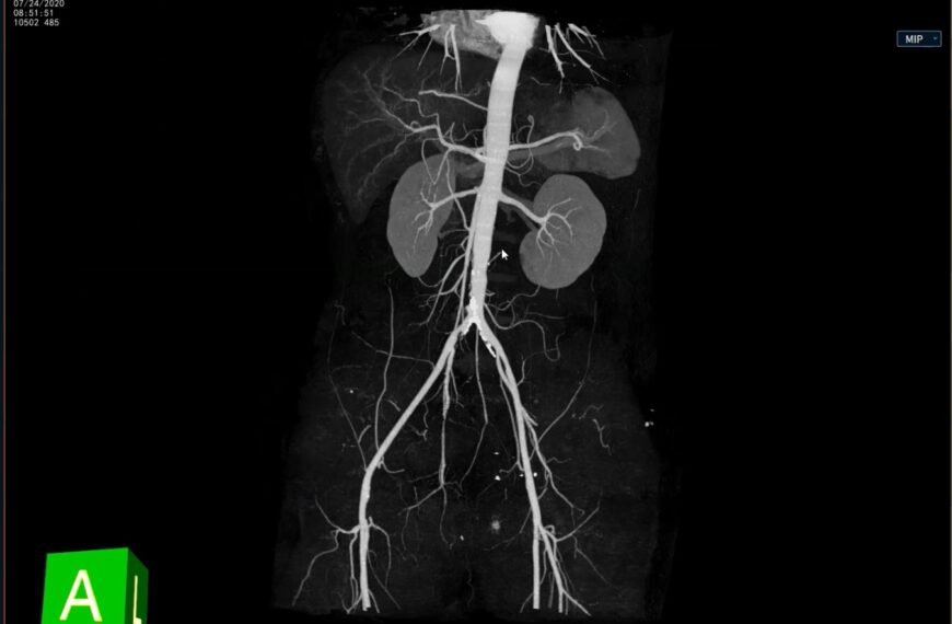 Mapeo vascular de alta precisión con IntelliAtlas